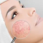 Tenul Cuperozic: Simptome, Tratamente, Produse de Îngrijire